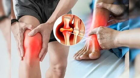 Obszary skóry odpowiednie do aplikacji żelu Icexin (kolana, łokcie, dolna część pleców)