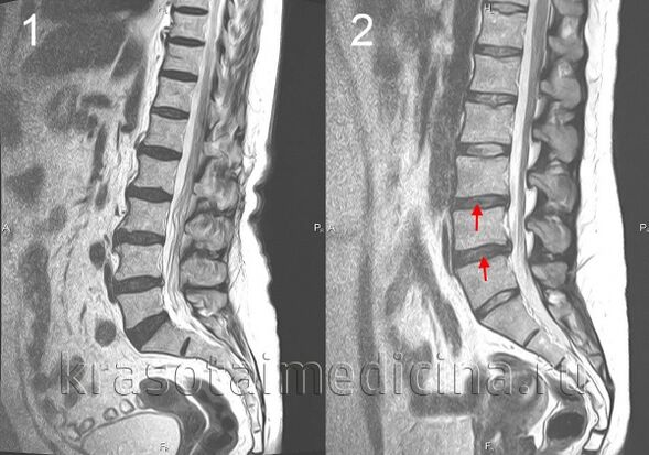 osteochondroza kręgosłupa
